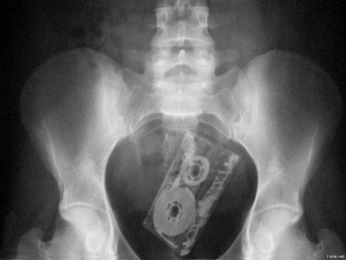 Инородные предметы в прямой кишке рентген