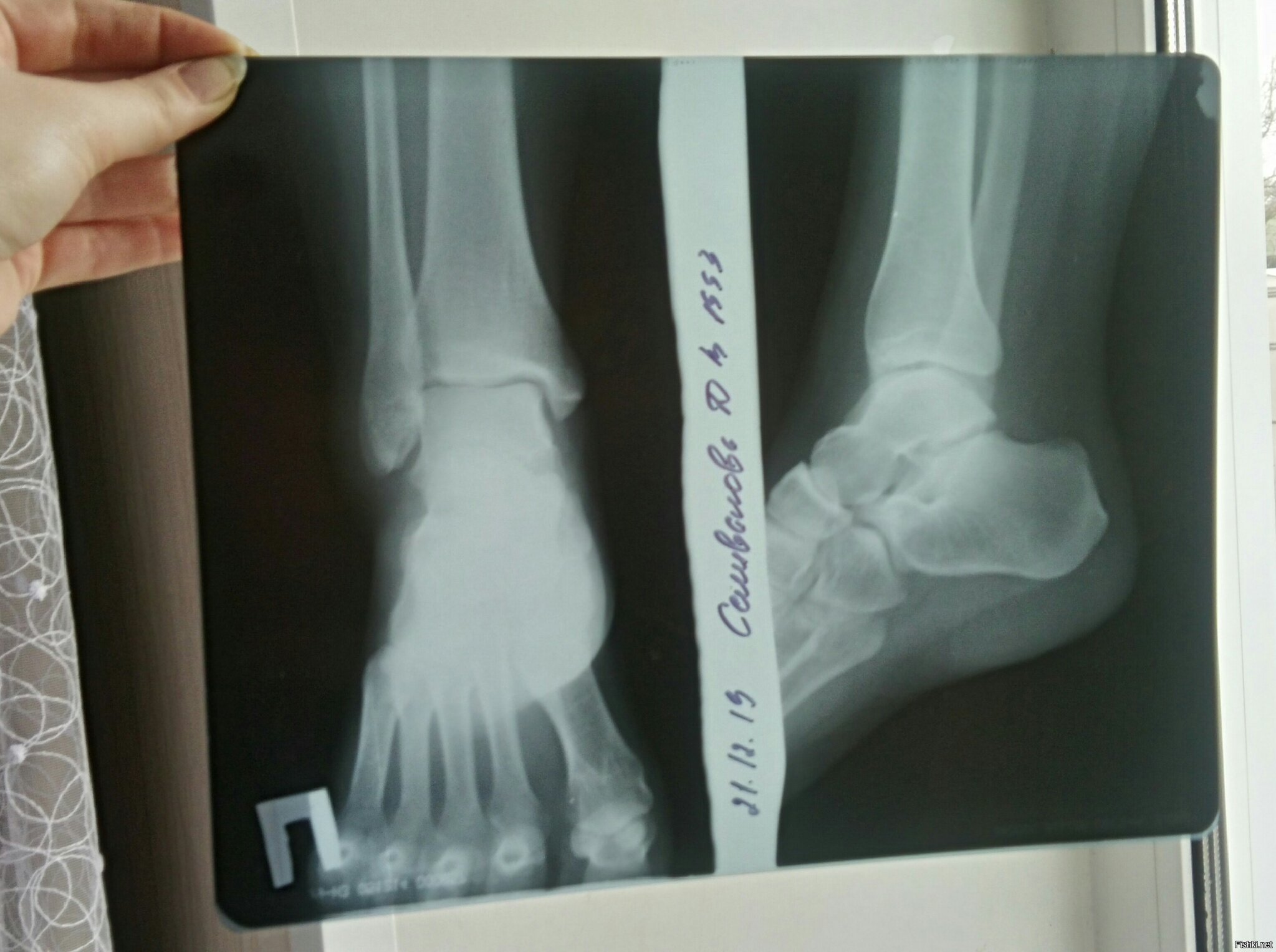 Снимок трещины. Снимок ноги рентген.