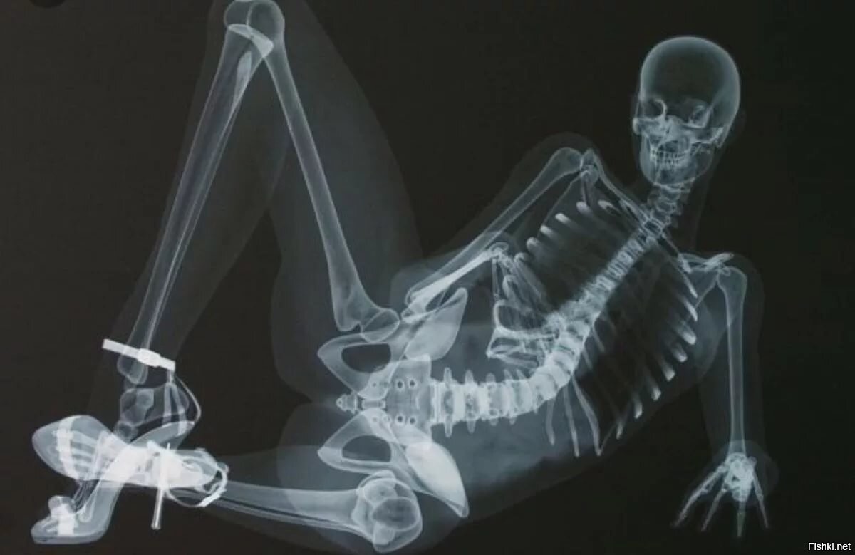 Рентгеновский снимок женщины