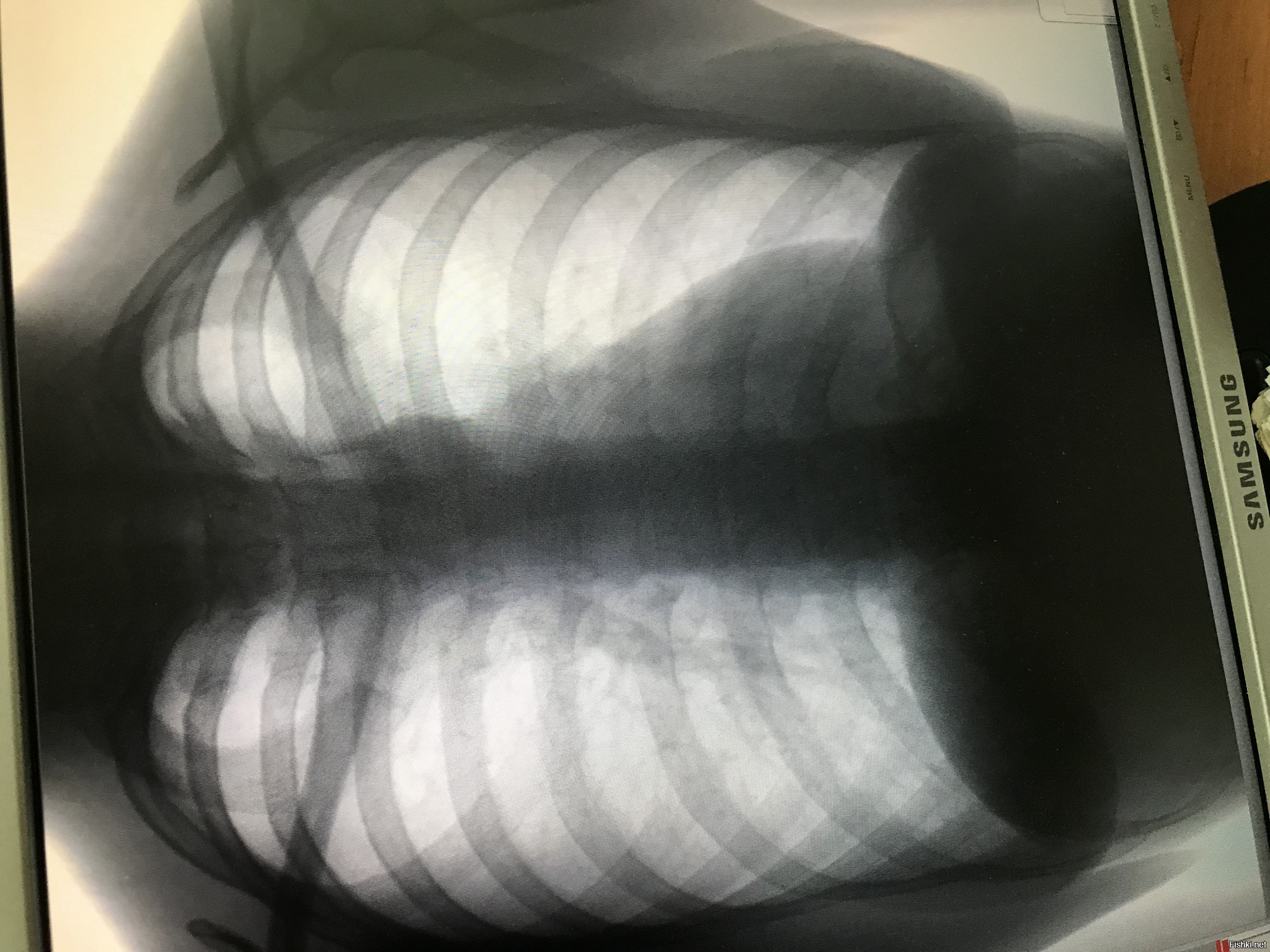 легкие вейпера фото рентген